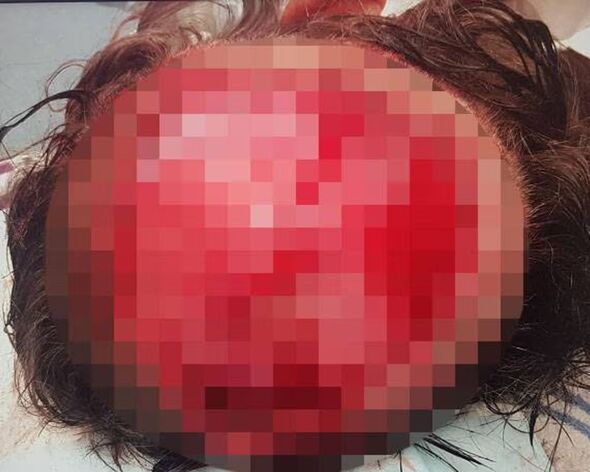 Blessure au cuir chevelu du Dr Winberg Blessure au cuir chevelu du Dr Winberg