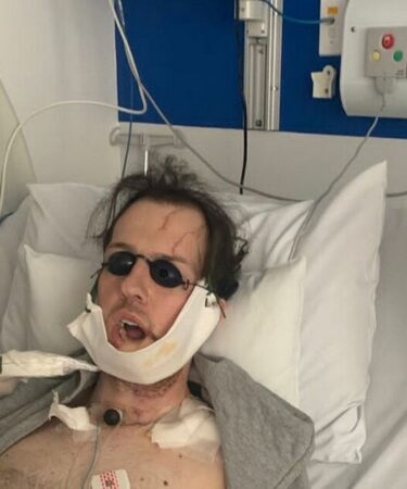 Un homme a la mâchoire reconstruite avec un os de jambe après une chute d'horreur en poursuivant un voleur